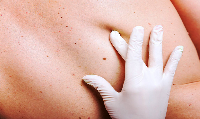 Aşırı güneş ışınları deri kanserine yol açabilir