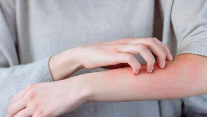 Şanlıurfa'da uyuz hastalığına yönelik bilgilendirme yapıldı