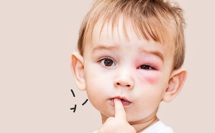 Arı-Böcek-Sivrisinek Sokmalarına Karşı Alınması Gereken 10 Önlem
