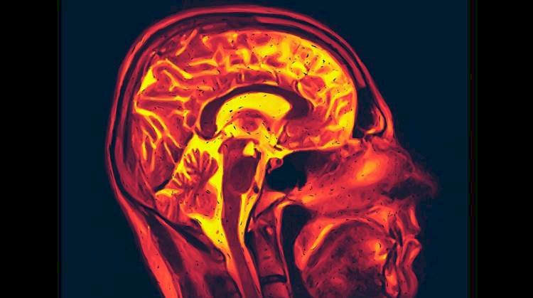 Spontan kimyası Alzheimer'ı yönlendirebilir
